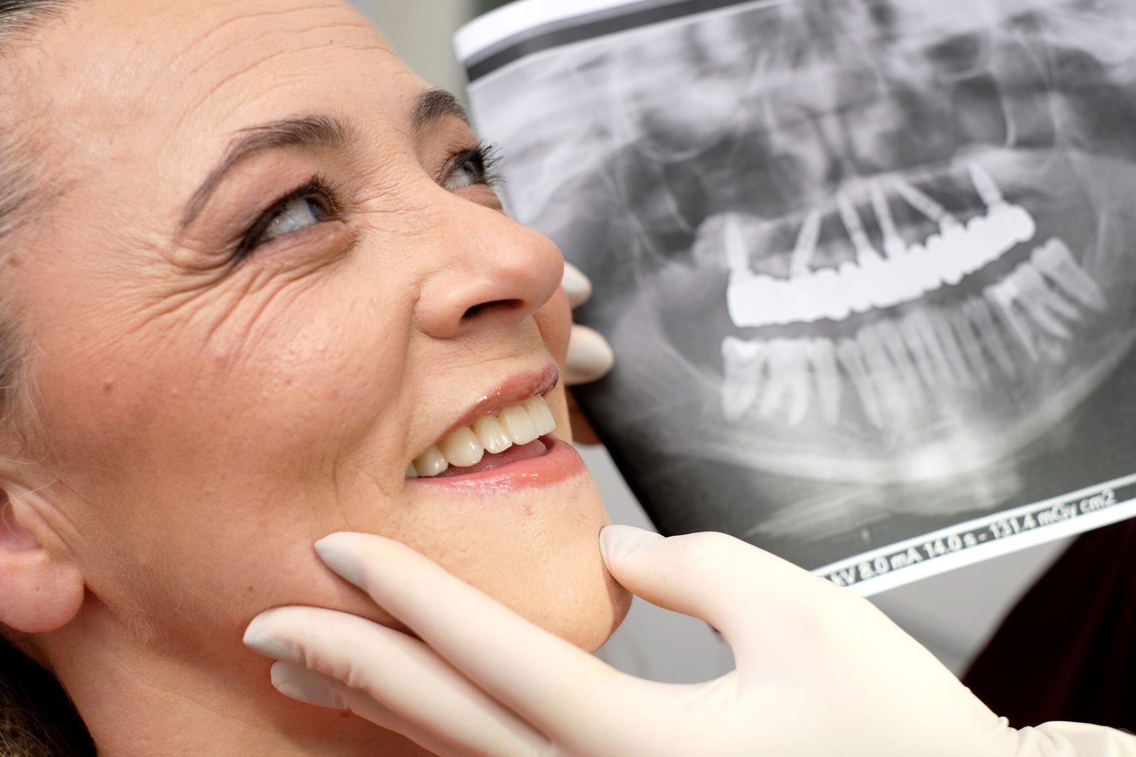 Como funciona a colocação de implantes dentários
